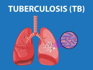 tuberculosis:-19k-cases-recorded-in-2023,-15%-increase-from-2022-figure-–-report