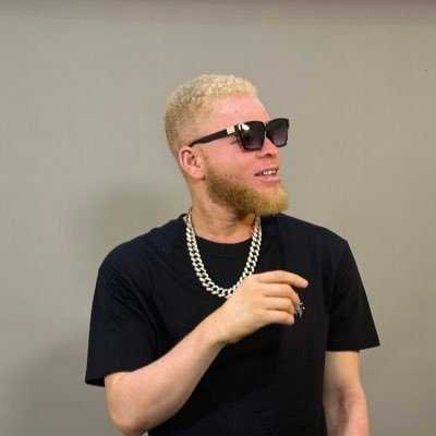 my-father-abandoned-me-at-birth-due-to-my-albinism-–-byno-ayoni
