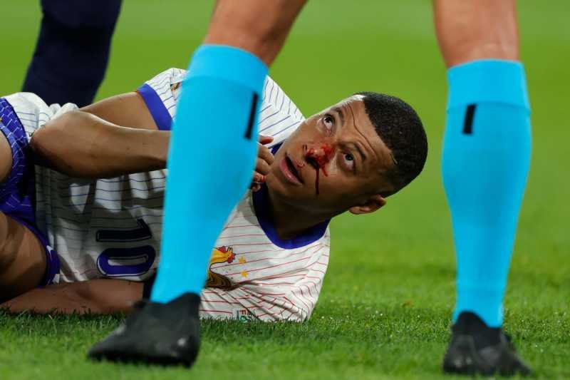 mbappe:-deschamps-provides-concerning-update-on-nose-injury