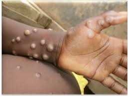 health-authorities-update-emergency-response-for-upsurge-in-monkey-pox-cases