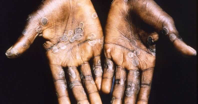 who-outlines-measures-to-tackle-mpox