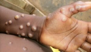 sweden-confirms-first-case-of-mpox